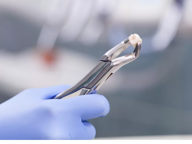 Dentysta stomatolog trzymający wyrwany chirurgicznie ząb